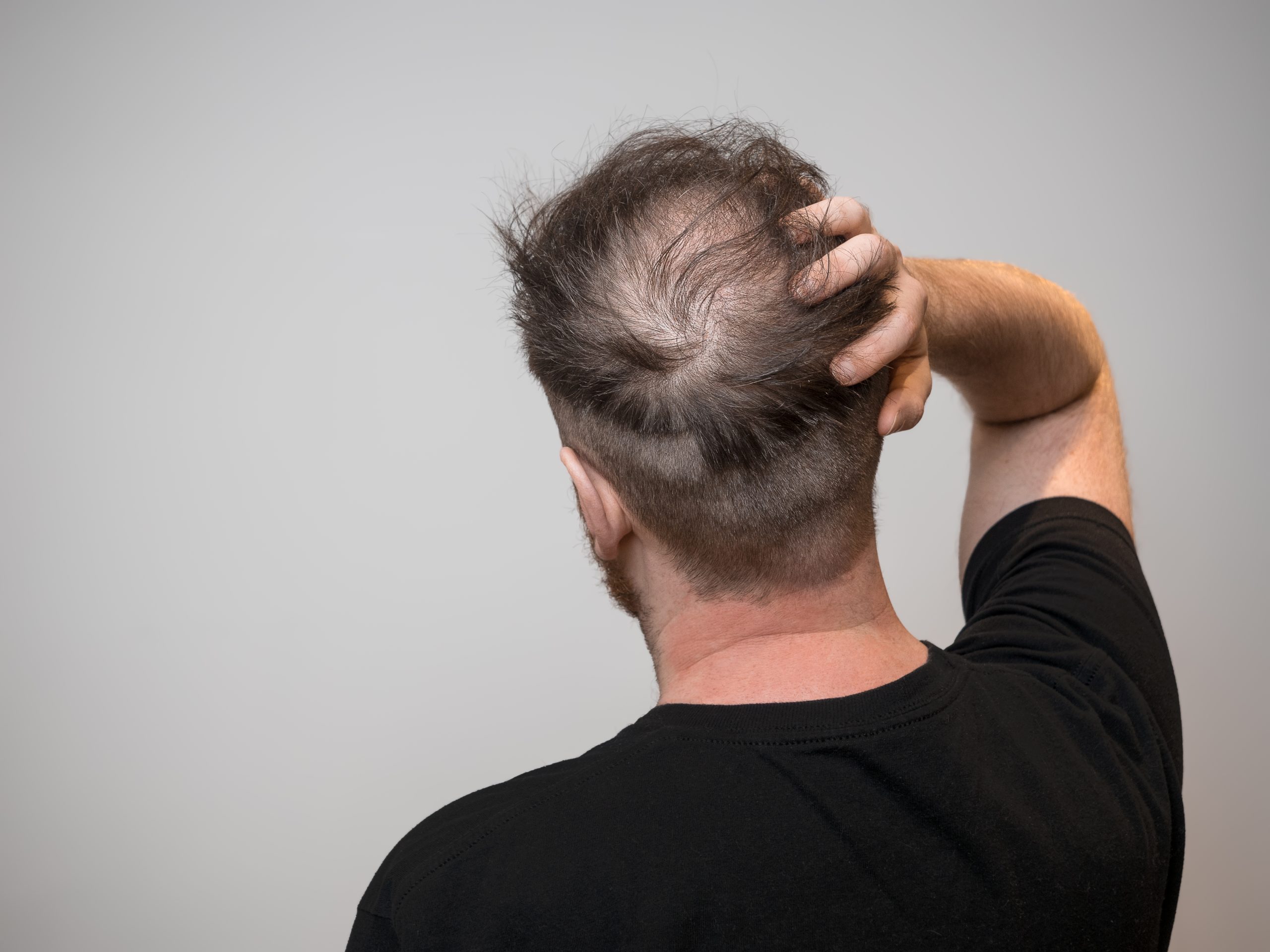 Why Am I Losing So Much Hair? Understanding Common Causes